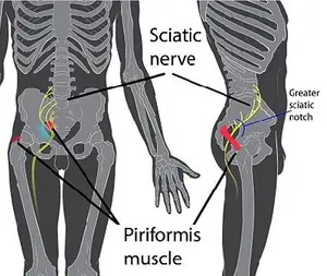 Massage for piriformis syndrome treatment can release tension in the tight piriformis muscle that is pressing on the sciatic nerve and causing pain.