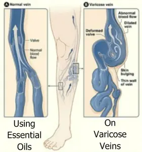 Using essential oils for varicose veins can help relieve discomfort and possibly make veins less noticeable. Learn about recommended oils & how to use them.