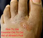 Explore the benefits of essential oils for athletes foot. Find effective blends and application techniques to combat fungi and refresh your feet.