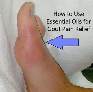 Learn how to use essential oils for gout pain relief. 