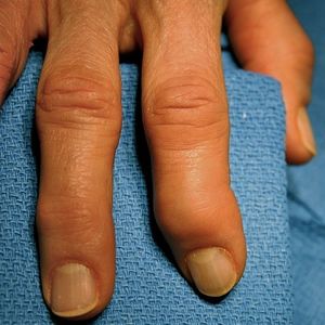 Fingers with arthritis