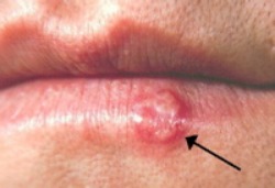 Cold Sore on Lip