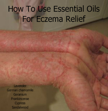 Recommended essential oils for eczema natural treatment include cypress, German chamomile, frankincense, geranium, juniper, lavender, melissa, and sandalwood. 