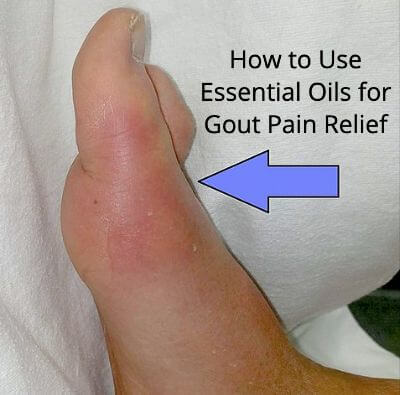 An inflamed big toe | Essential Oils For Gout Pain Relief