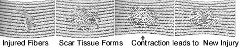 Injured soft tissue fibers