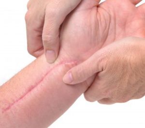Massaging Scar on Arm