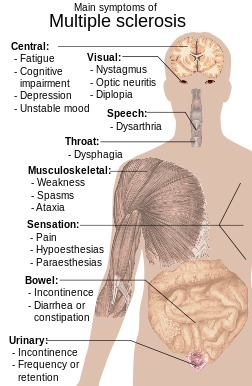 Chart showing symptoms of Multiple Sclerosi