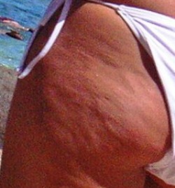 Essential Oils for Cellulite Essential Oils for Cellulite