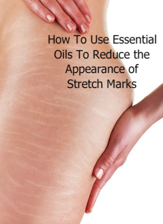Stretch marks on woman's thigh with the words How to Use Essential Oils to Reduce the Appearance of stretch marks.