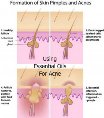 Diagram of the layers of the skin explaining how acne forms.