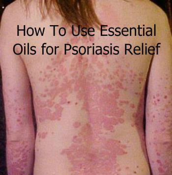 Using Essential Oils for Psoriasis Relief Using Essential Oils for Psoriasis Relief