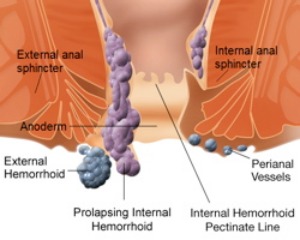 Illustration of Hemorrhoid | Essential Oils for Hemorrhoids