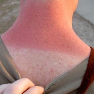 Using Essential Oils for Sunburn Relief Sunburned neck